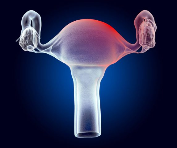 uterine fibroids treatment