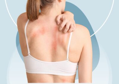Cholinergic Urticaria