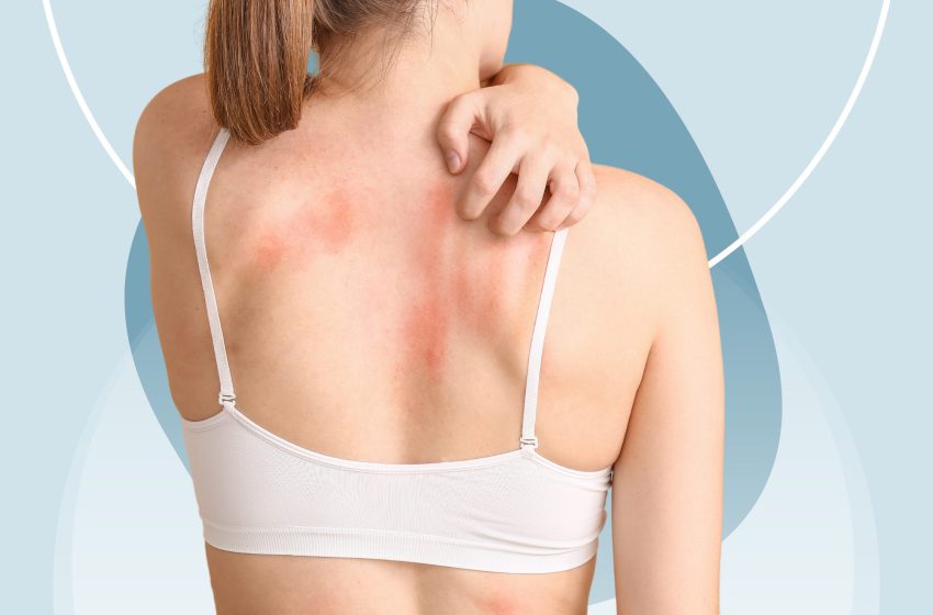 4 Ways To Treat Cholinergic Urticaria: Complete Guide 2023