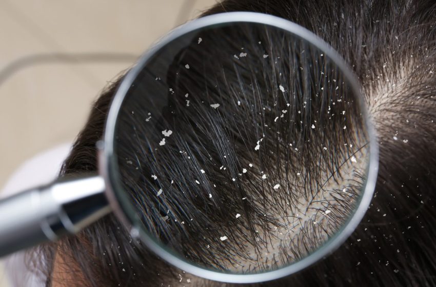  13 Best Dandruff Shampoos • Top Dandruff Remedies of 2023