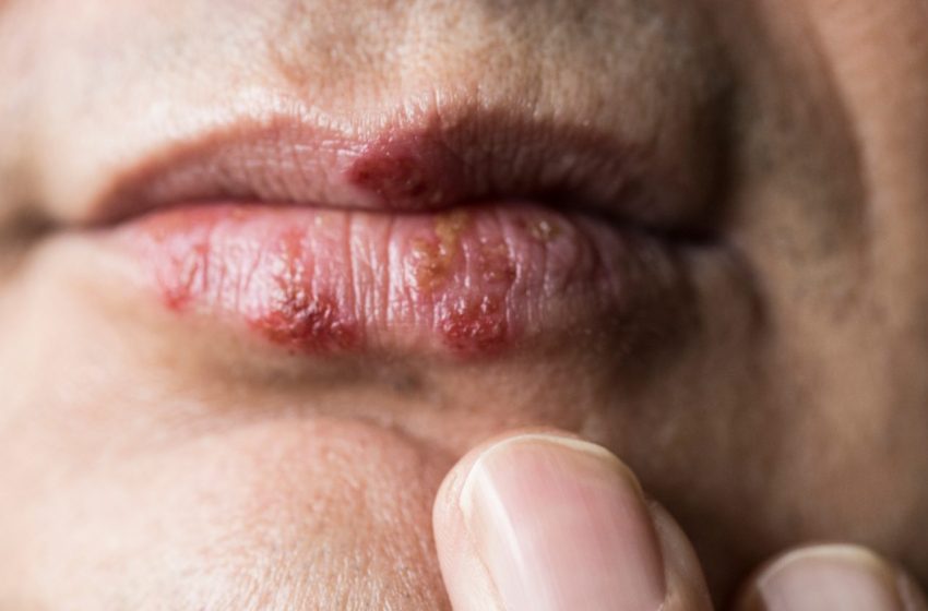 Is There A Herpes Cure? Complete Guide 2023
