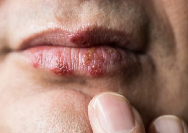 Is There A Herpes Cure? Complete Guide 2022