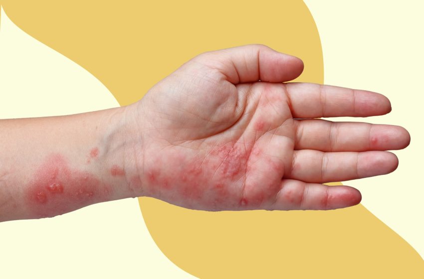  6 Signs of Early Shingles & 4 Ways to Treat It