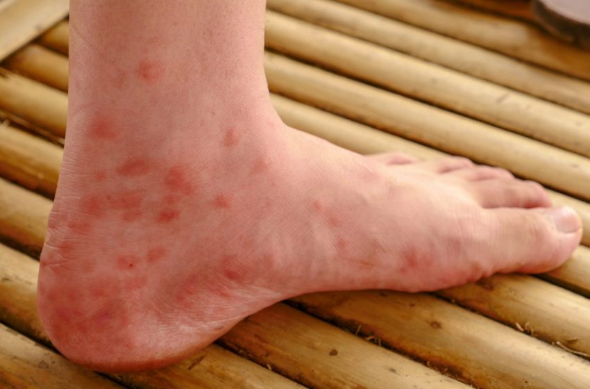 2 Ways To Treat Chigger Bites: Complete Guide 2023