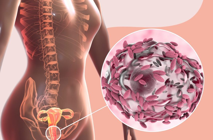 3 Ways On How To Get Rid of BV (Bacterial Vaginosis): Complete Guide 2023