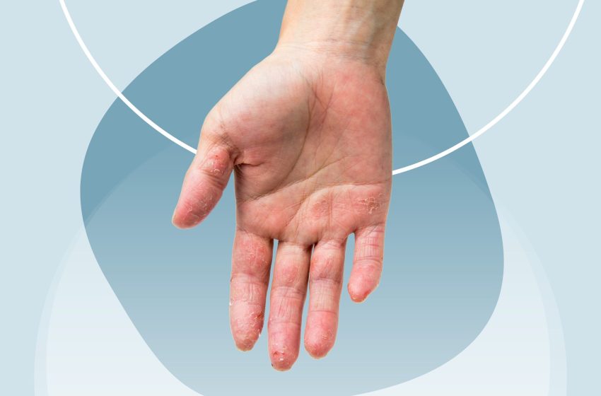  Is Dyshidrotic Eczema Contagious? What You Should Know About Dyshidrosis