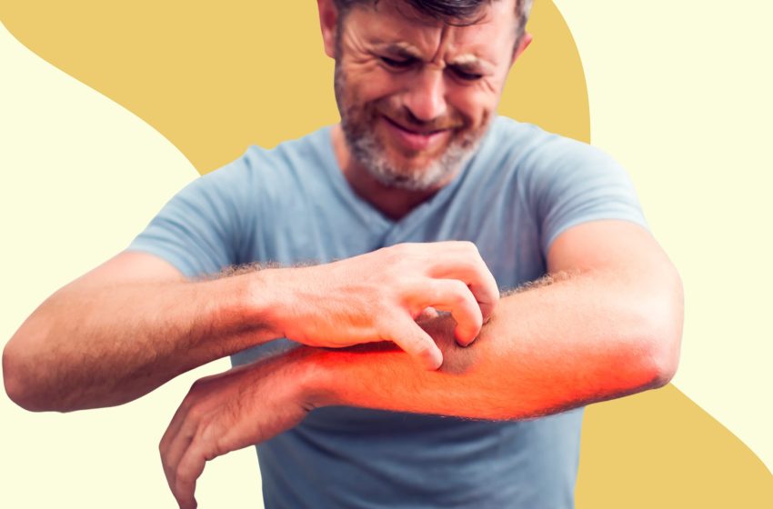  4 Ways To Treat Jock Itch: Complete Guide 2023