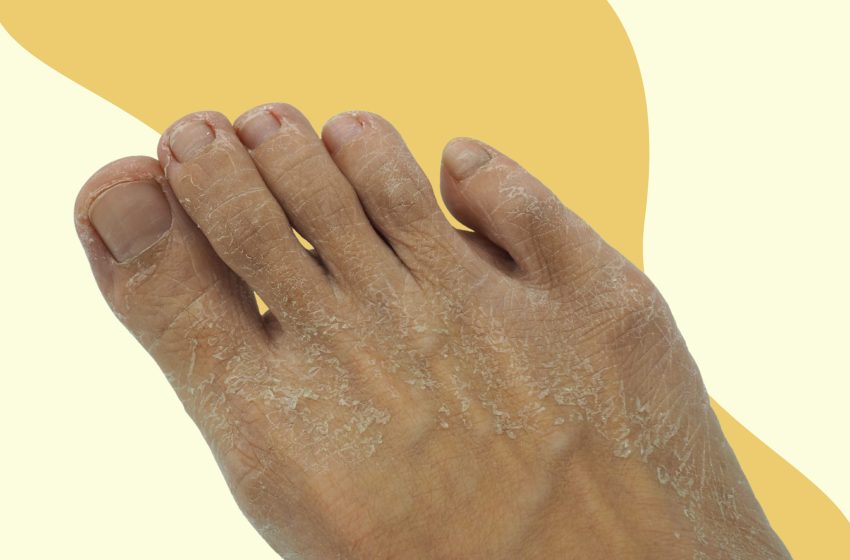  Why Are My Feet Peeling ? 4 Causes:  Complete Guide 2023