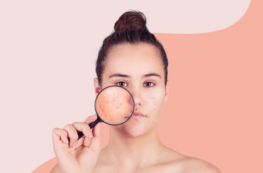  3 Ways To Remove Dark Spots On Your Face According To Dermatologists