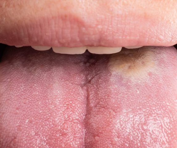 oral thrush
